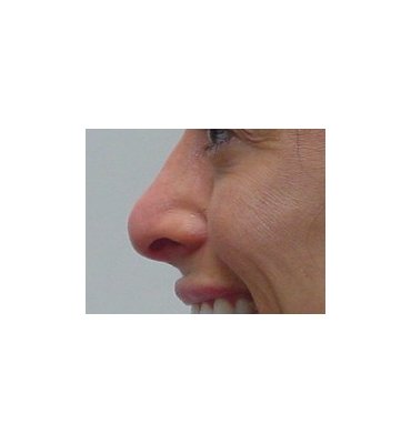 liquid rhinoplasty